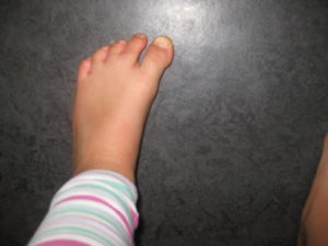 Bunion Treatment Without Surgery - Ideal Foot