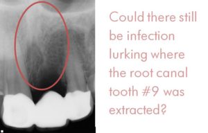 root-canal-infection-gone