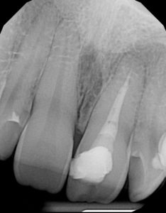 Root-Canal-Infection